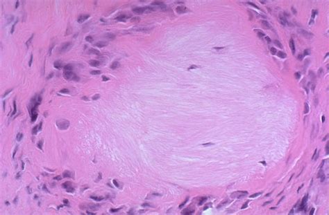 Tophus Histology