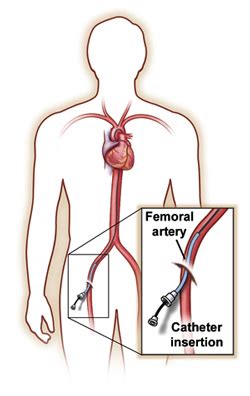 Basic information about Angiogram and its utilities