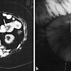 (PDF) Jejunojejunal Lipoma Causing Intussusception