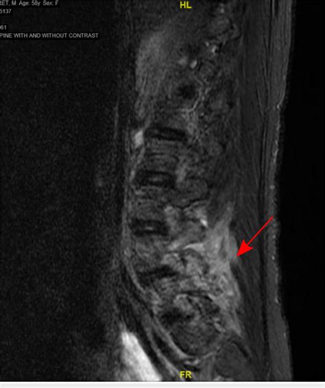 MRI of the lumbar spine showing epidural abscess (red arrow) | Download Scientific Diagram