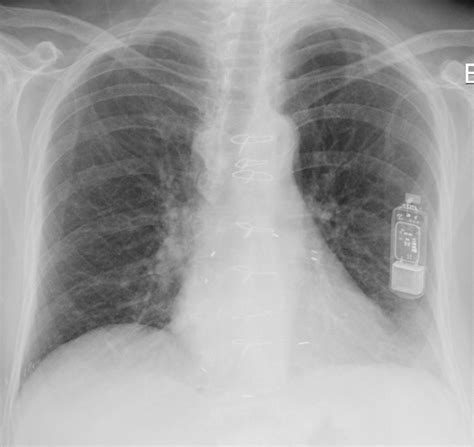 Implanted Cardiac Loop Recorder