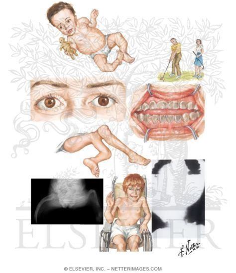 Osteogenesis Imperfecta Type Iii Category Labeled Title Pictures ...