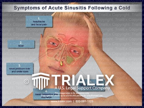Symptoms of Acute Sinusitis Following a Cold - TrialExhibits Inc.