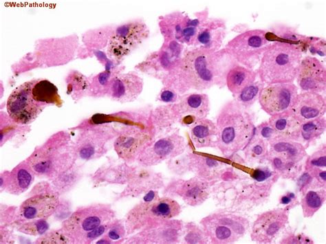 Webpathology.com: A Collection of Surgical Pathology Images