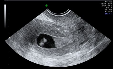 Uterine Cancer Ultrasound Images