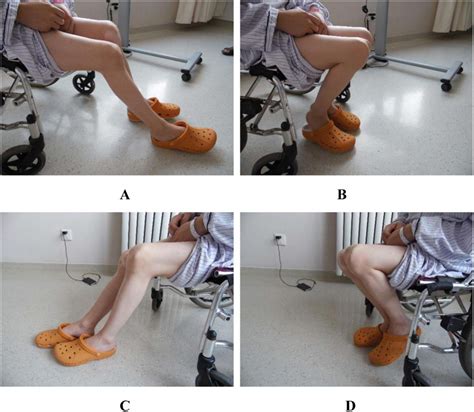 Management of knee flexion contracture in haemophilia with the Ilizarov ...