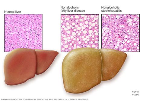 Stéatose hépatique – Canadian Liver Foundation