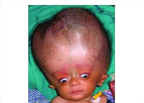 Image of a child with Alexander syndrome with hydrocephalus and... | Download Scientific Diagram