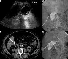 Percutaneous cholecystostomy in the management of acute cholecystitis – 10 years of experience