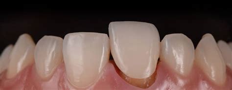 Dental Crown Benefits - Dentist Brisbane