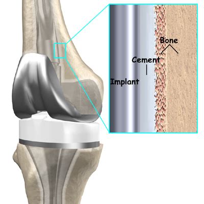 Revision Arthroplasty of the Knee | eOrthopod.com