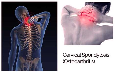 Cervical Osteoarthritis