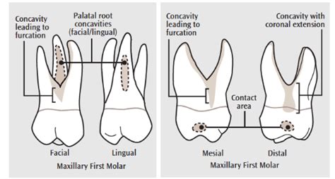 Hand Instrumentation of First Molar Teeth - Dimensions of Dental Hygiene