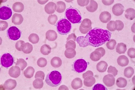 Podcast: Diagnosing and Treating Chronic Lymphocytic Leukemia | Patient Care