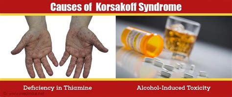 Korsakoff Syndrome - Causes, Symptoms, Diagnosis, Treatment & Prevention