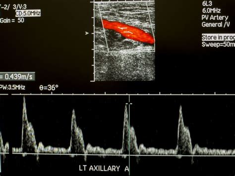 Venous Thrombosis Ultrasound