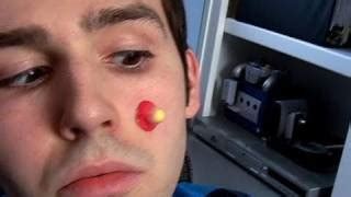 Biggest Pimple In The World