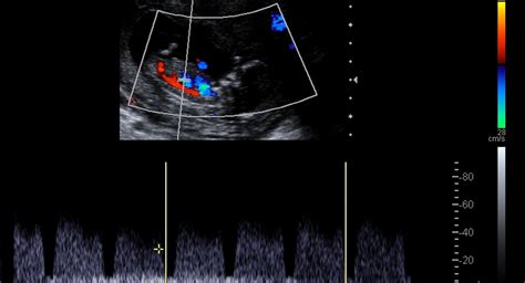 Doppler ultrasound scans in pregnancy - BabyCenter India