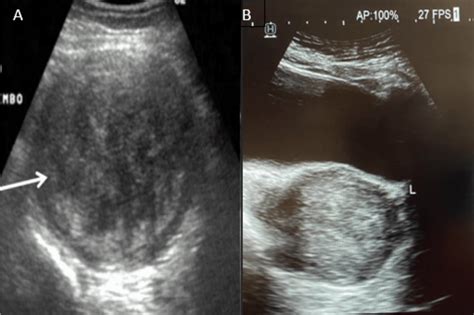 Cureus | Expulsion of Infarcted Myoma Following Ultrasound-Guided Uterine Artery Embolization: A ...