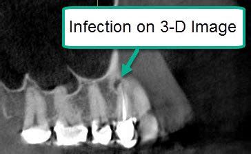 Root Canal Infection Xray