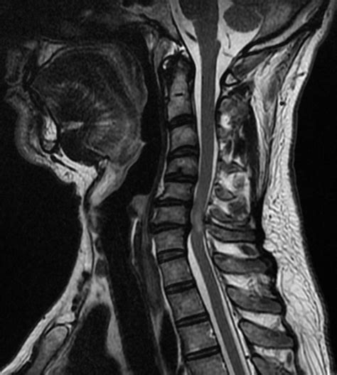 What is the Difference Between Cervical Radiculopathy and Myelopathy | Compare the Difference ...