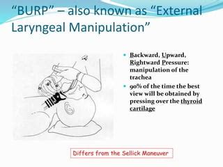 sellick maneuver, BURP , OELM | PPT | Free Download