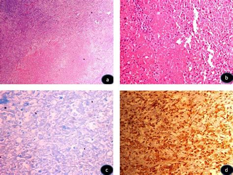 (A) (×100) and (B) (×200) On histopathology, excision biopsy of the ...