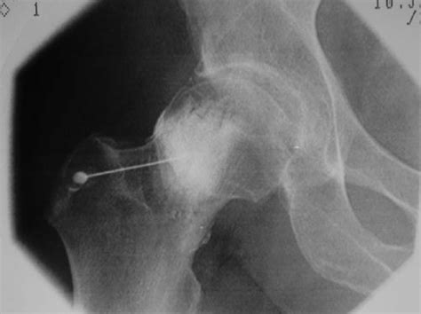 6. Fluoroscopic image of intra-articular hip injection (courtesy of Dr.... | Download Scientific ...