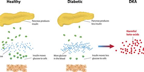 Diabetic Ketoacidosis | OnCallmeters.com