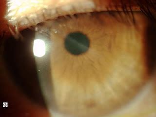 Sonoran Desert Eye Center: CORNEAL SCAR