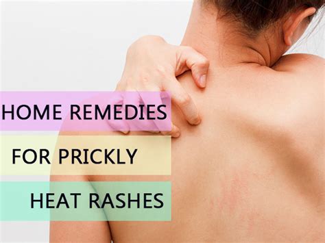 11 Effective Home Remedies For Heat Rash (Prickly Heat) - Boldsky.com