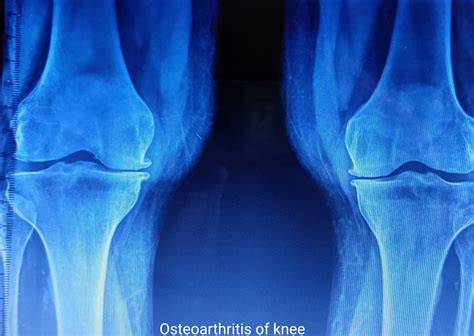 Arthritis -Part 2 - Osteoarthritis-Signs and Symptoms : Dr. K. P. V. Rao