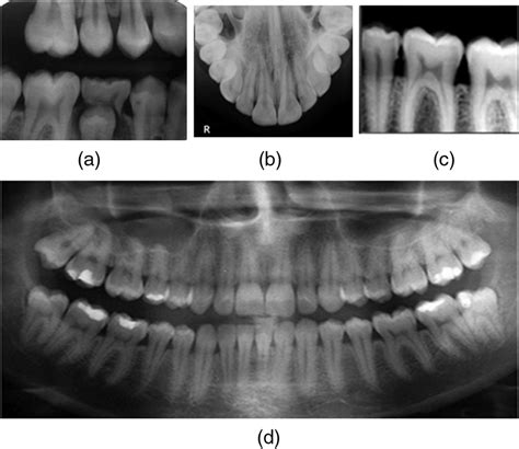 Dental radiographs. (a) Bitewing. (b) Periapical. (c) Occlusal. (d ...