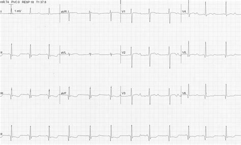 Hypokalemia Ecg Strip