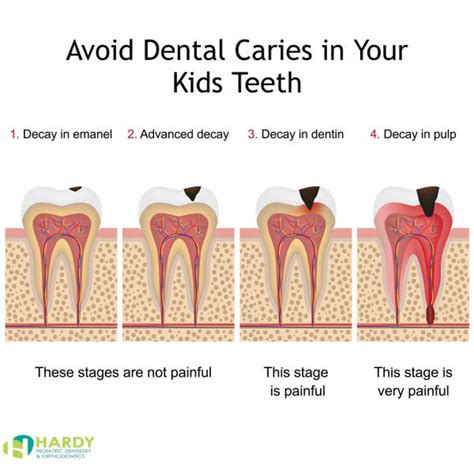 How Your Child Can Prevent Getting Cavities (Caries) - Hardy Pediatric Dentistry & Orthodontics