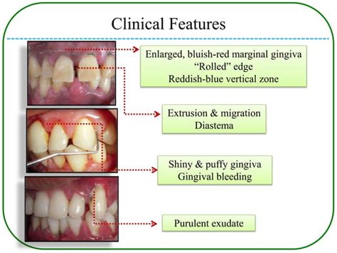 Periodontal pockets | PPT