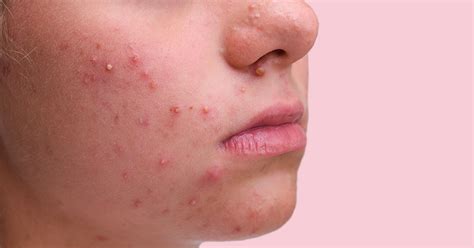 Fungal Acne: Causes And Treatment | Ova SG