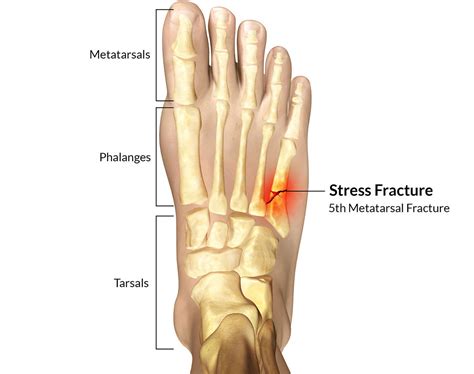 5th Metatarsal Fracture - Motus Physical Therapy