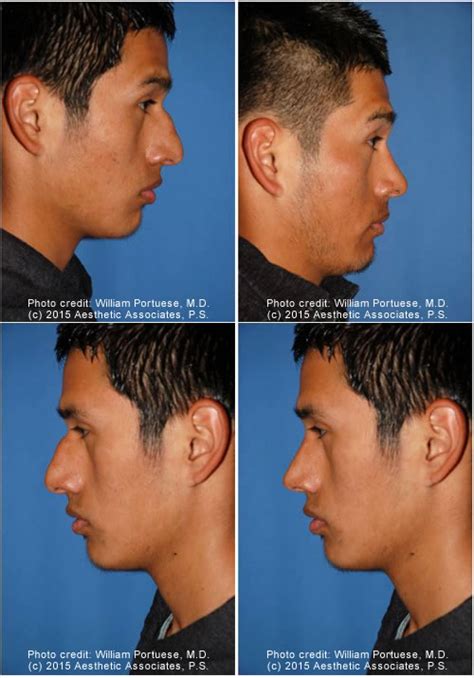 Flat Nose Before and After Photo Gallery - Nose Surgery Photos