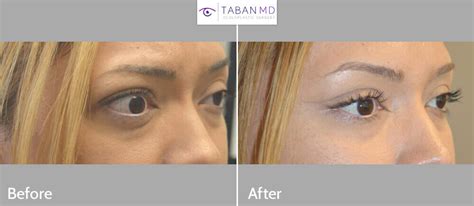 Graves Disease Before and After Gallery | Taban MD