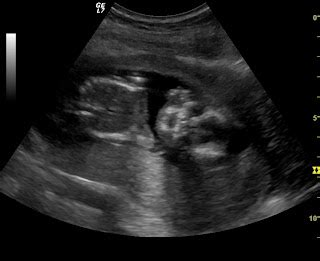 Hyphin et.al.: 15 week ultrasound!!!