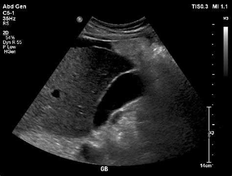 Gallbladder Ultrasound Stones