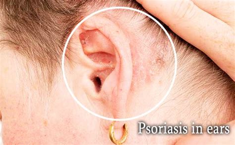 Psoriasis in ears – Causes, Symptoms & Treatment | Psoriasis expert