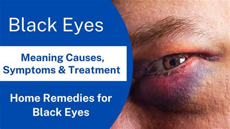 Black Eye: Causes, Symptoms, Prevention, and Treatment | Home Remedies ...