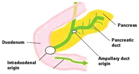 Ampullary cancer causes, symptoms, diagnosis, staging & treatment