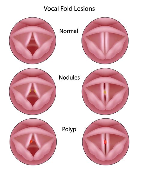 vocal-cord-nodules-and-polyps- Pediatric Pulmonologists