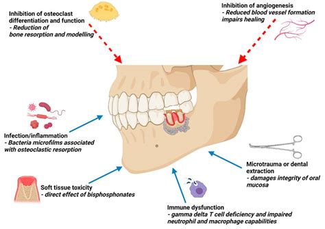 Bisphosphonates Side Effects