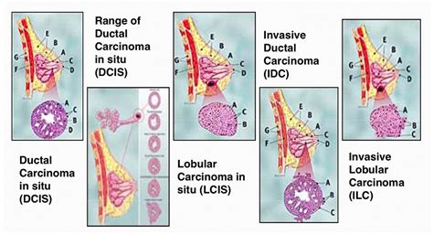 What Do The Stages Of Breast Cancer Mean - BEST HOME DESIGN IDEAS