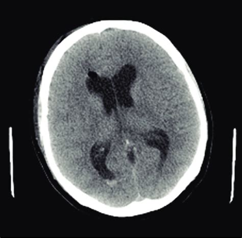 Brain CT after ETV+cystectomy surgery. | Download Scientific Diagram