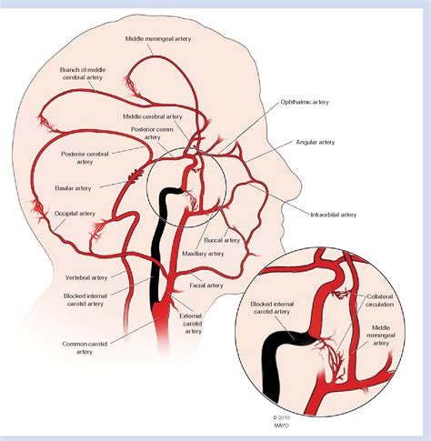 Figure 2 from Carotid artery disease: stenting vs endarterectomy. - Semantic Scholar